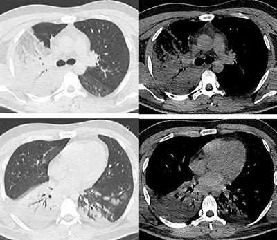 Fulminant fatal pneumonia and bacteremia due to Aeromonas dhakensis in an immunocompetent man: a case report and literature review